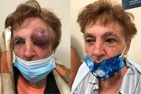 Image result for Merkel Cell Carcinoma