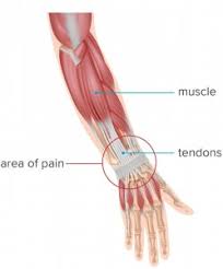 Forearm flexor muscles, labeled drawing. Guitar Tendonitis A Winning Strategy Guitarstrength