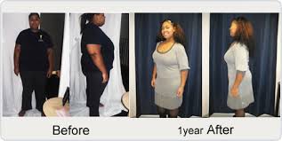 This significant weight loss over a short period of time causes excess skin to build up in certain areas of the body. Before After Pictures Testimonials Gastric Bypass Before After Testimonials After Obesity Surgery San Francisco California