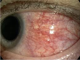 Image result for Scleritis