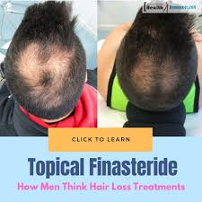 To put it simply, propecia stops the body converting testosterone into dihydrotestosterone (dht). Topical Finasteride How Men Think About Hair Loss Treatments Synesy