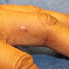 Sarcoidosis is a rare disease caused by inflammation. Sarcoidosis And Squamous Cell Carcinoma A Connection Documented In A Case Series Of 3 Patients Mdedge Dermatology