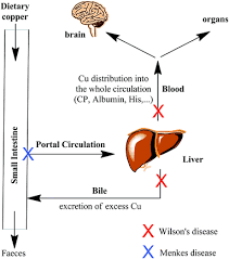 chelation therapy in wilsons disease from d penicillamine