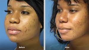 Find quick results from multiple sources. Rhinoplasty Westfield Nj Burnett Plastic Surgery