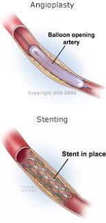 Occlusive Disease Oregon Surgical Specialists