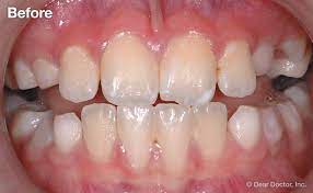 Some studies report that it starts forming as soon as five minutes after it is removed. Plaque Disclosing Agents
