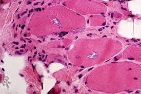 Image result for Polymyositis