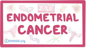 This is one of the most common symptoms of uterine cancer, whether it's in between your periods, after sex, or after menopause.unusual vaginal bleeding is usually a symptom of advanced uterine cancer because it means that the tumour is spreading. Endometrial Cancer Causes Symptoms Diagnosis Treatment Pathology Youtube