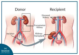 Image result for Transplantation