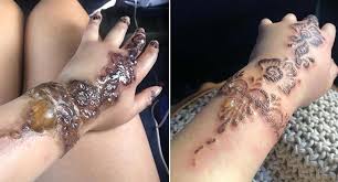 Fda warns about hidden dangers of 'temporary' henna tattoos that burn, blister and leave skin scarred for life. Australian Traveller S Gruesome Reaction To Henna Tattoo
