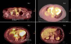 A pet scan is the best method to determine if mesothelioma has spread to other parts of the body. Fdg Pet Ct Images Malignant Pleural Mesothelioma Of The Right Pleural Download Scientific Diagram