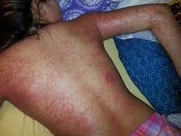Allergic Reaction To Penicillin A Very Inflamed Itchy Rash That Covered Her Body From Head To Toe It Started On The Itchy Rash Allergic Reaction Amoxicillin