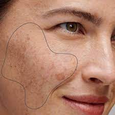 5 Things You Need To Know Before Getting Melasma Treatment in Dubai