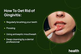 Image result for Gingivitis