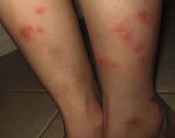 Image result for Papular urticaria