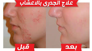 تعد حبوب اللقاح من أهم العلاجات الشاملة التي يتم استخدامها في جميع أنحاء البلاد ورغم. Ø§ÙØ¥Ø±ÙØ§Ø¨ Ø§ÙØ¹Ø¨Ø§Ø±Ø© Ø¯ÙØ±ÙØ© Ø¢Ø«Ø§Ø± Ø§ÙØ¬Ø¯Ø±Ù Ø§ÙÙØ§Ø¦Ù ÙÙ Ø§ÙÙØ¬Ù Leojanssen Com