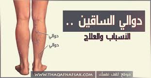 دوالي الساقين وجع الساق لا يحتمل المنام