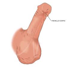 Cómo mejorar tus relaciones sexuales corrigiendo el frenillo corto del  pene? Procedimientos y soluciones desde la cirugía plástica - Dra. Claudia  Nieto