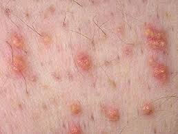 A xanthoma is a deposit of fat on the skin, commonly around the eyes, joints, hands or feet. Image Eruptive Xanthoma Msd Manual Profi Ausgabe