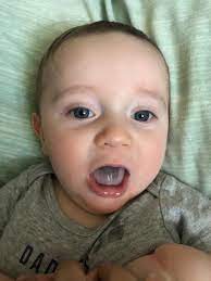 Sometimes, a nutritional deficiency, such as vitamin c deficiency, can contribute to the risk of black tongue that's caused by an infection.5if your child has been avoiding certain foods, talk to their pediatrician about whether they should take vitamin supplements. Helppp What S This On My Baby S Tongue Thrush Or Black Hairy Tongue October 2017 Babies Forums What To Expect