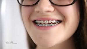 Braces are a breeding ground for germs and bacteria inside the mouth. Brace Yourself Those Teeth Will Cost A Lot To Fix Stuff Co Nz