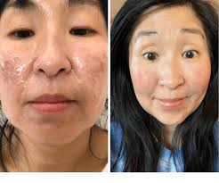 Halo hybrid fractional laser before and after. My Experience With Halo Hip Foodie Mom