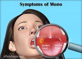 It is common among teenagers and young adults, especially college students. A Guide On Early Symptoms Of Mono Signs Of Mononucleosis In Adults And Toddlers