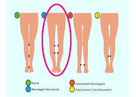 Image result for Genu Varum