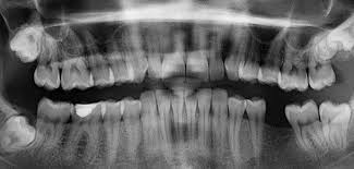 After roughly 4 or 5 teeth ex. What To Do If You Lose A Tooth As An Adult Tips To Prevent Permanent Tooth Loss Madison Dentists Advice Total Care Dental Madison Wisconsin