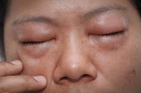 Maybe you would like to learn more about one of these? Bagaimana Cara Penyakit Chagas Didiagnosis