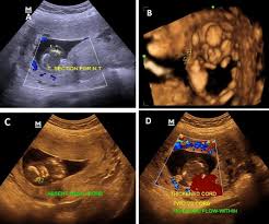 A measurement of the size of the translucent space behind the neck of the fetus using ultrasound at between 10 and 14 weeks of pregnancy, reflecting the amount of fluid that has accumulated under the skin of the fetus.nuchal translucency tends to be increased in chromosome disorders such as turner syndrome and down syndrome. The Diagnostic Performance Of 4d Ultrasound In Nuchal Translucency And Anomalies Association Sciencedirect