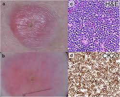 Abstract merkel cell carcinoma (mcc) is a rare, clinically aggressive cutaneous neuroendocrine neoplasm with a high mortality rate. Merkel Cell Carcinoma Updates On Pathogenesis Diagnosis And Management Springerlink
