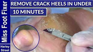 It serves to hydrate the corn. Deep Seed Corns Removing And Popping By Miss Foot Fixer Marion Yau Youtube