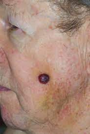 This indication is approved under accelerated approval based on tumor response rate and durability of response. Ulcerated And Crusted Locally Advanced Merkel Cell Carcinoma Of The Download Scientific Diagram