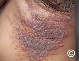 Image result for Pemphigus