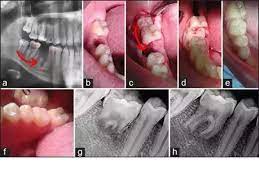 If the wisdom tooth has not fully erupted the older you are having a wisdom tooth removed the longer it will take to recover. Can A Wisdom Tooth Replace A Bad Molar Quora