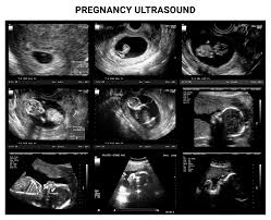Image result for First Trimester Ultrasound