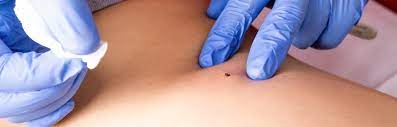 Warts Removal Tampa FL - Wart Removal Treatment Dade City FL