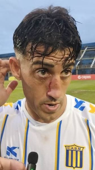 Testimonios Federal A: Mitre 0 - Sol de América 0. LEONARDO MORALES,  jugador de Mitre y las marcas que le dejó el partido.