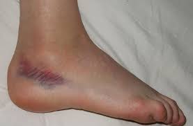 Grade 3 ankle sprain pictures. Ankle Sprains Need R R Too Sports Medicine Research