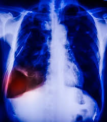 What happens when you vape. Another Possible Covid Complication Punctured Lung Cidrap