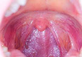 Pain may be felt a few seconds after swallowing, as food or liquid reaches the tumor and has trouble getting around it. Throat Cancer S Link To Oral Sex What You Should Know Cleveland Clinic