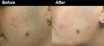 The way laser hair removal works, i soon discovered from a quick bit of precautionary research, is that pulses of highly concentrated light are emitted when i read that 90 percent of laser hair removal patients who are good candidates for the procedure report permanent hair loss after an average of. Is Laser Hair Removal Permanent Myths Facts