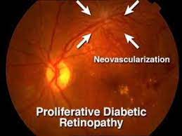 Retinal Eye Exam Eye Health Optician Training Optometry