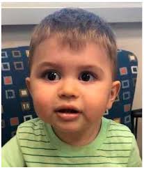 Stickler Syndrome: A Review of Clinical Manifestations and the Genetics  Evaluation