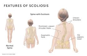 Idiopathic Scoliosis Boston Children S Hospital