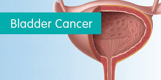 Image result for Bladder Cancer Staging