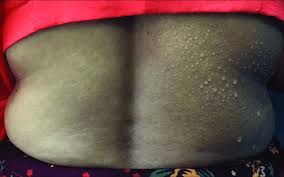 Image result for Anhidrosis