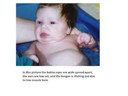 Down Syndrome By Emily Gough What Is Down Syndrome Down Syndrome Is A Disorder That Includes A Combination Of Birth Defects Among Them Some Degree Ppt Download