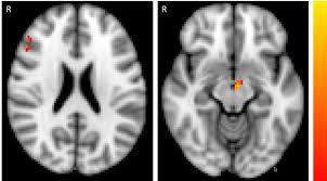 She says she'll be late finishing work. Abnormal Reward Prediction Error Signalling In Antipsychotic Naive Individuals With First Episode Psychosis Or Clinical Risk For Psychosis Neuropsychopharmacology